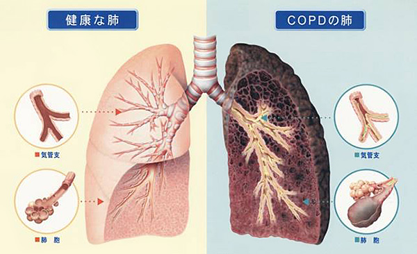 健康な肺とCOPDの肺の比較