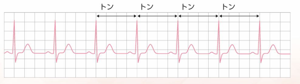 健康な心臓の心電図