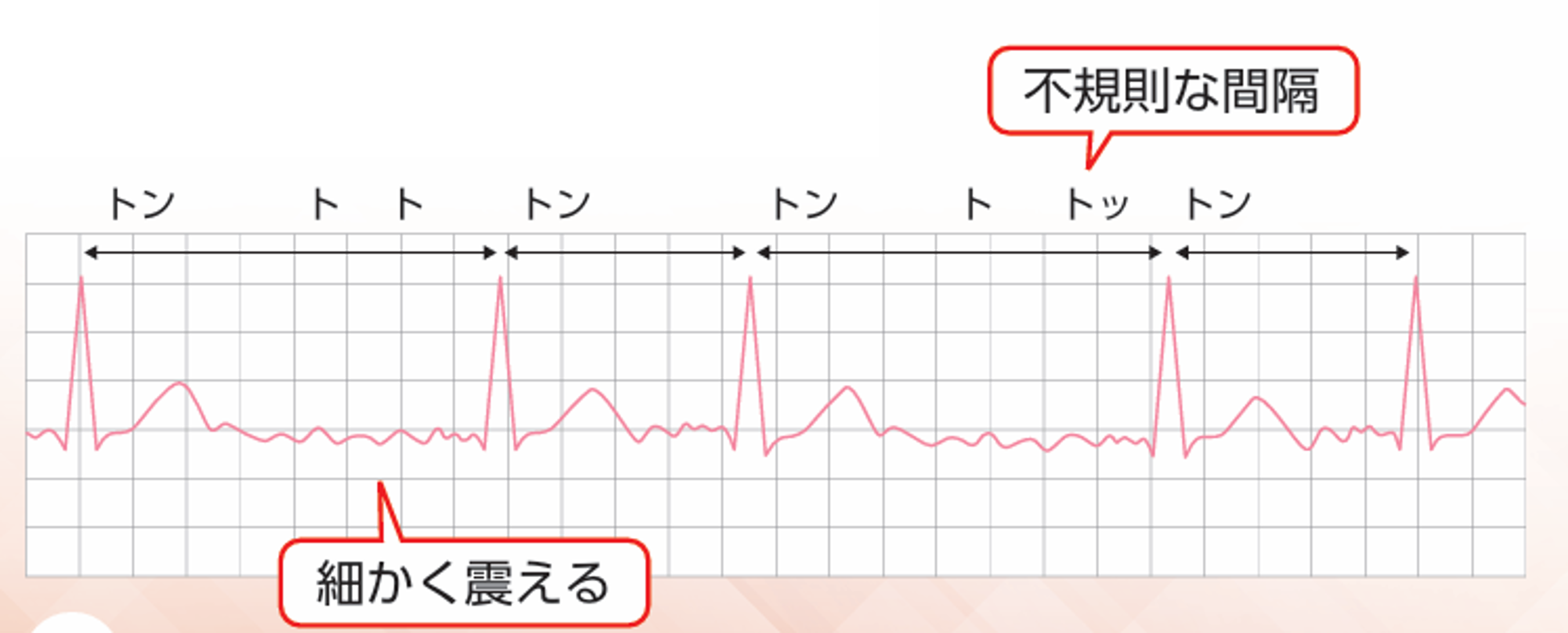 心房細動の心電図