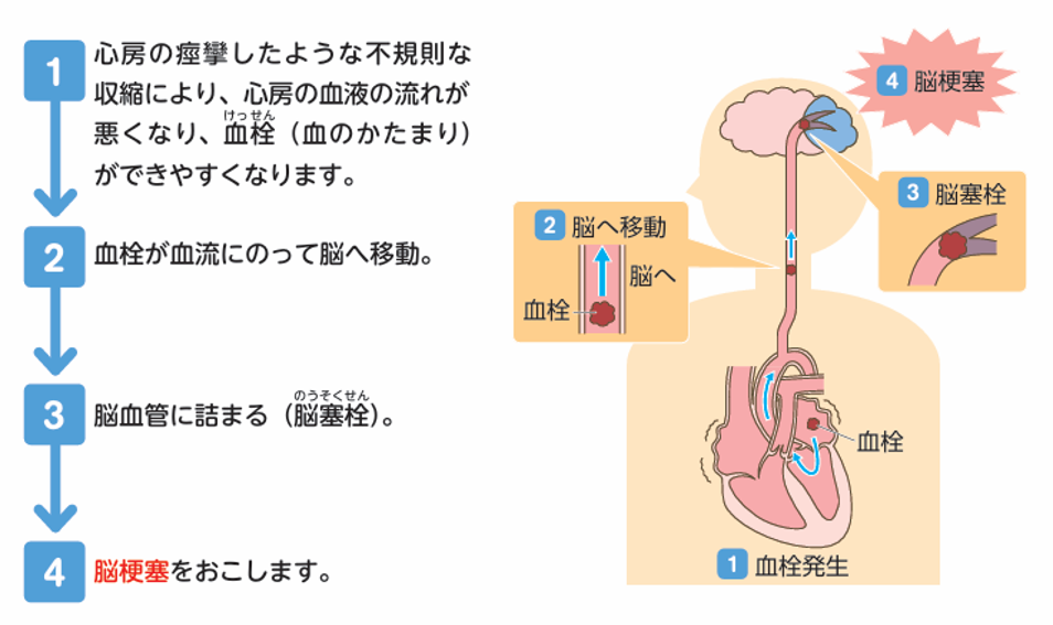 脳梗塞の発症までの流れ
