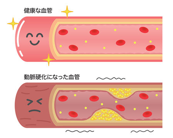 動脈硬化になった血管の様子