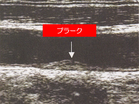動脈硬化ありの状態