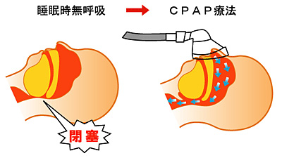 CPAP治療の効果