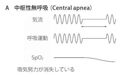 中枢無呼吸(Central apnea)