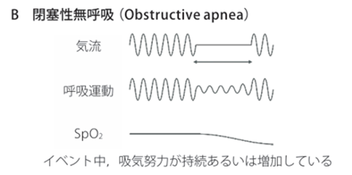 閉塞性無呼吸(Obstructive apnea)