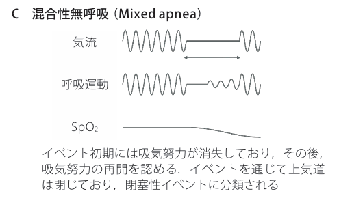 混合性無呼吸(Mixed apnea)