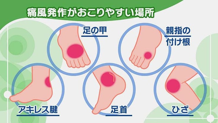痛風発作が起こりやすい場所