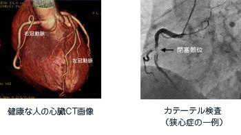 健康な人の心臓CT画像とカテーテル検査